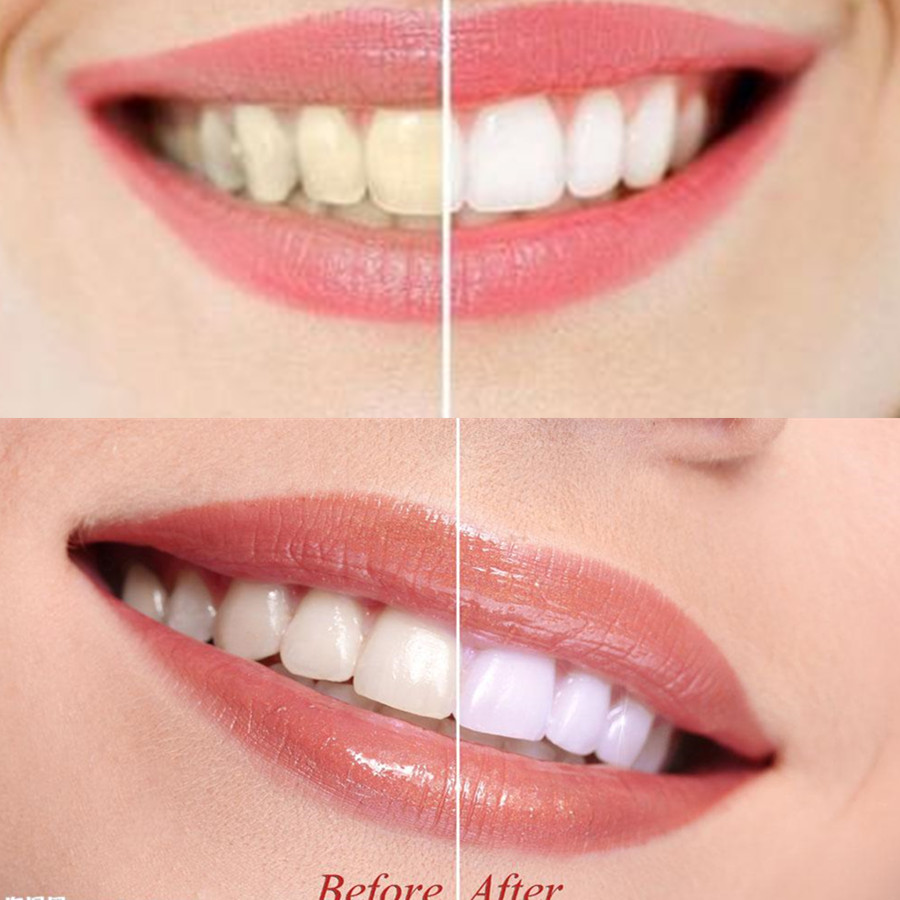 Bambu kömür diş diş diş hekimi - Teeth Whitening Yellow Teeth incelemesi ve fiyatı