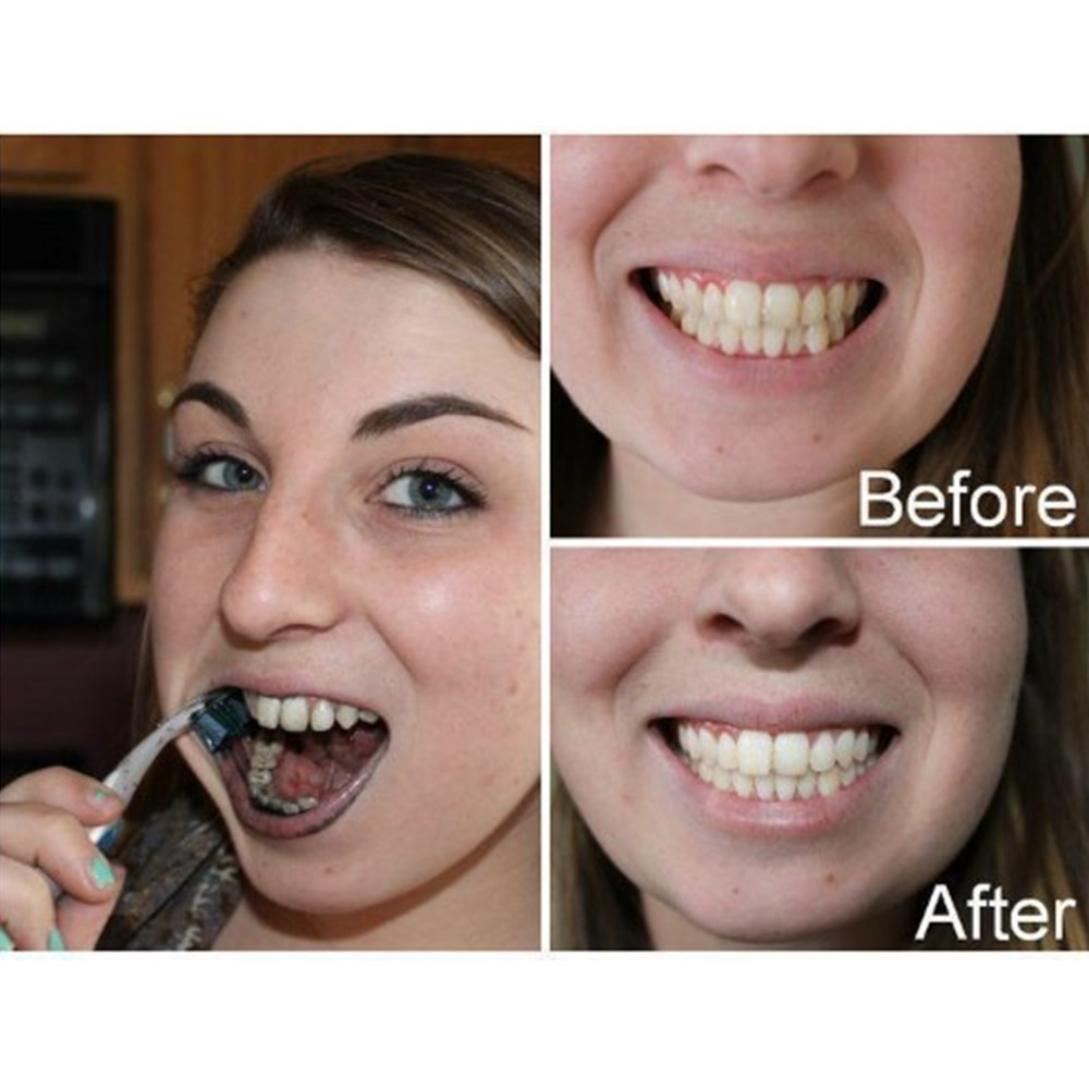 Bambu kömür diş diş diş hekimi - Teeth Whitening Yellow Teeth incelemesi ve fiyatı