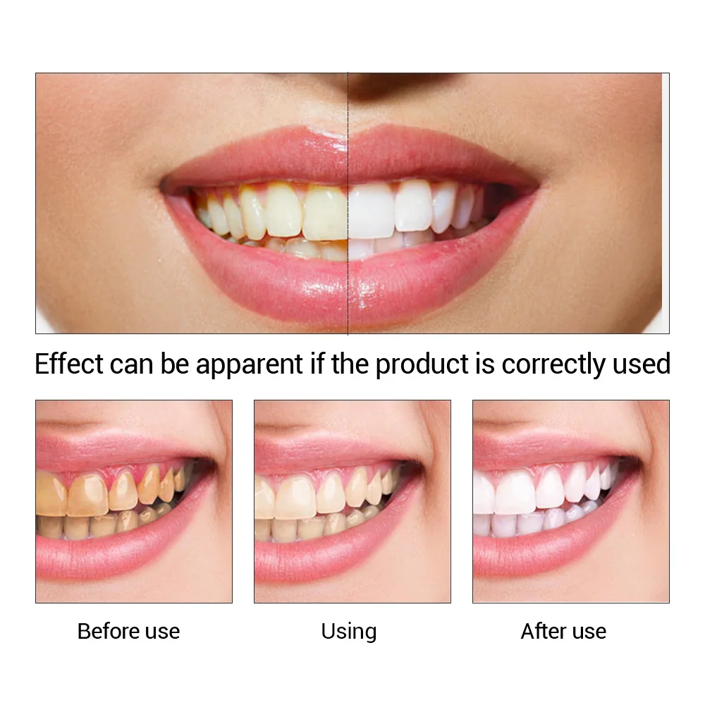 FTEENPLY diş beyazlatma özü to - Teeth Whitening Price incelemesi ve fiyatı
