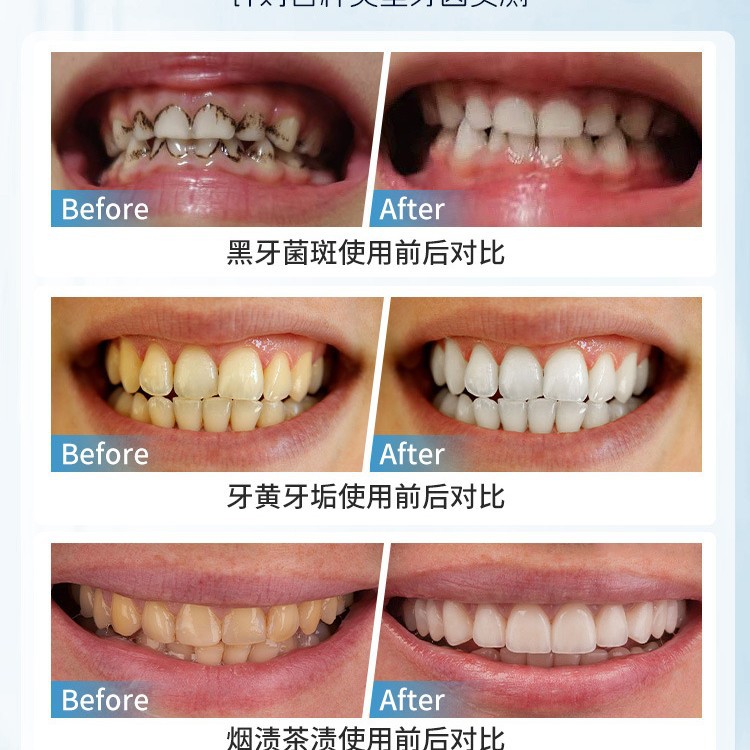 Japonya Manuel Diş Leke Çıkarm - Teeth Whitening In Japan incelemesi ve fiyatı