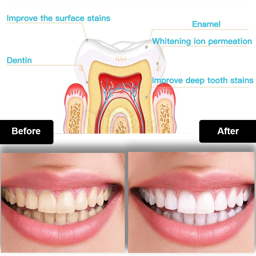 Diş Diş Beyazlatma Kiti Mini 1 - Teeth Whitening Price incelemesi ve fiyatı